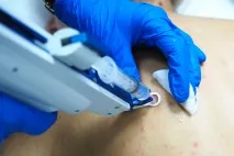 Як позбутися прищів на спині причини та відгуки, Beauty Insider прищів