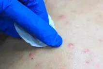 Як позбутися прищів на спині причини та відгуки, Beauty Insider позбутися