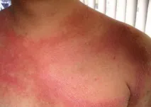 лікування