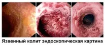 Коліт - симптоми, причини, лікування, профілактика, Геморой причини