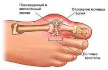 подагрі