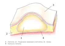 Лікування ліпоми в Ізраїлі ліпоми