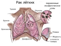 Лікування раку легень народними способами прополіс, мухомор, АСД, трави лікування