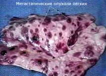 Метастатичні пухлини легень, Система «ОНКОНЕТ» легень