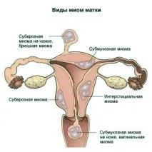 матки