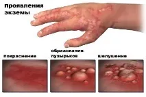 Симптоми екземи симптоми