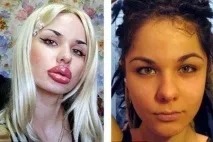 Пластика зірок - фото до та після, Портал Естетика фото