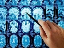 Втрата пам’яті – причини, що покаже мрт при порушеннях пам’яті втрата