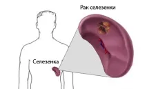 Рак селезінки лікування