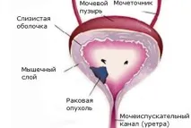 Рак сечового міхура у дитини причини, симптоми, лікування, операція симптоми