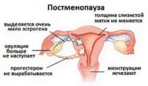 Серозометра в постменопаузі що це таке, ознаки та лікування постменопаузі