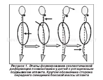 Сколіоз – це не хвороба! сколіозу