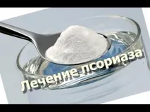 Сода, сіль та йод ефективні компоненти для лікування псиріазу компоненти