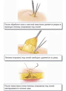 Видалення ліпоми хірургічним шляхом та лазером ліпоми