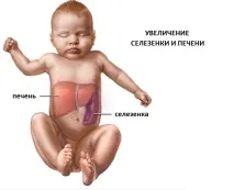 Хвороба Гоше причини, симптоми, фото, діагностика та лікування гоше
