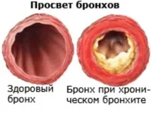 Бронхіт у дорослих симптоми та лікування бронхіт