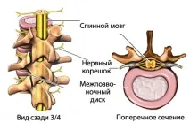 міжхребцевих
