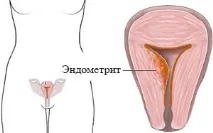 Ендометрит - що це таке, симптоми та лікування таке