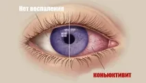 Гнійний кон’юнктивіт симптоми у дітей та дорослих дітей