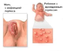 Генітальний герпес герпесу