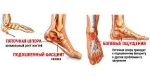 Що таке шпора п’яти і як її лікувати без операції таке