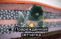 Що таке діабетичний макулярний набряк діабетичний