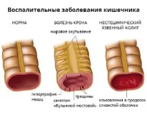 Коліт виразковий симптоми та причини, діагностика та лікування коліт