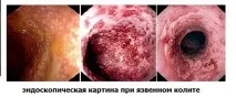 Коліт виразковий симптоми та причини, діагностика та лікування симптоми