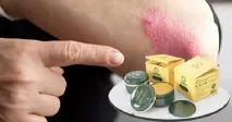 псоріазу