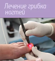 Лікування грибка нігтів у Самарі лікування