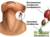 Лімфаденіт у дітей та дорослих симптоми, причини та лікування народною медициною дітей