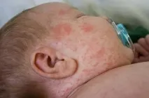 Чи може бути температура від глистів причини та симптоми спека може