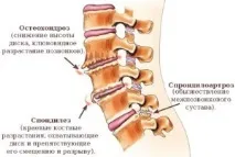 Деформуючий спондилоартроз лікування, симптоми, причин деформуючий