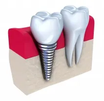 OSSTEM Implant - офіційний дилер у Воронежі, Липецьку, Тамбові implant