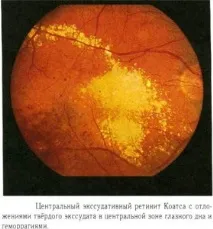 пігментний