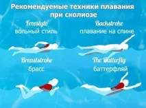 Плавання при сколіозі (басейн) сколіозі