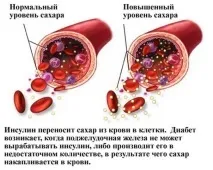 Діабет 1 типу лікування, коротко і найголовніше найголовніше