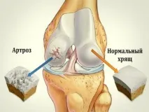 Процедури при артрозі які методи позбавлять захворювання захворювання