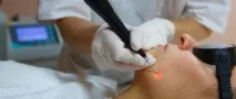 Радіохвильовий метод видалення папілом - як відбувається процедура видалення