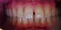 aligners