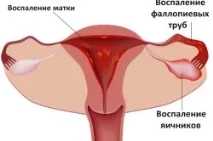 Запалення яєчників симптоми та лікування запалення