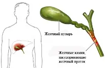 холециститу