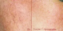 лікування