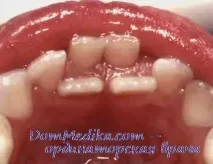 Аномалії розвитку зуба розвитку