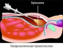 Стегнова грижа у чоловіків та жінок - лікування, симптоми чоловіків