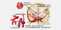 Німотоп - усунення загрози та наслідків інсульту усунення
