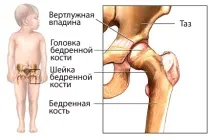 Дисплазія кульшових суглобів у новонароджених ознаки, діагностика, лікування кульшових