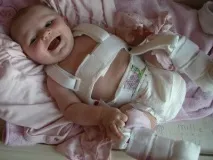 Дисплазія кульшових суглобів у новонароджених ознаки, діагностика, лікування суглобів