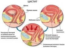 Гемороїдальний цистит у жінок, причини, лікування причини