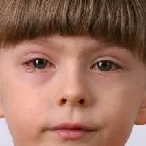 Ochi înflăcărați la un copil simptome, cauze, metode de tratament